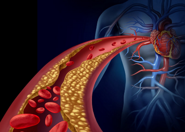 نویدبخشی siRNA برای درمان بیماری قلبی ناشی از Lp(a) 